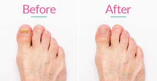 Fungal Laser Nail Treatment in Chicago, IL 60614 before after