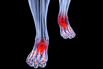 Arthritic foot and ankle care treatment, foot arthritis treatment in the Cook County, IL: Chicago (Cicero, Evanston, Skokie, Berwyn, Oak Park, Park Ridge, Niles, Morton Grove, Elmwood Park, Melrose Park, Maywood, Norridge, Forest Park) areas