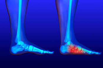 Flat feet and Fallen Arches treatment, Flatfoot Deformity Treatment in the Cook County, IL: Chicago (Cicero, Evanston, Skokie, Berwyn, Oak Park, Park Ridge, Niles, Morton Grove, Elmwood Park, Melrose Park, Maywood, Norridge, Forest Park) areas