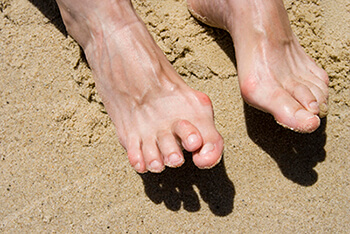 Hammertoes treatment in the Cook County, IL: Chicago (Cicero, Evanston, Skokie, Berwyn, Oak Park, Park Ridge, Niles, Morton Grove, Elmwood Park, Melrose Park, Maywood, Norridge, Forest Park) areas