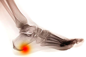 Heel spurs treatment in the Cook County, IL: Chicago (Cicero, Evanston, Skokie, Berwyn, Oak Park, Park Ridge, Niles, Morton Grove, Elmwood Park, Melrose Park, Maywood, Norridge, Forest Park) areas