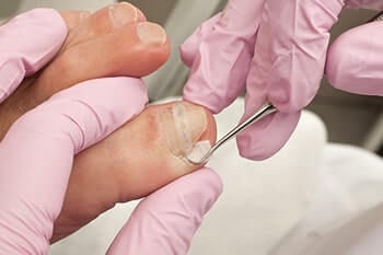 Ingrown toenails treatment in the Cook County, IL: Chicago (Cicero, Evanston, Skokie, Berwyn, Oak Park, Park Ridge, Niles, Morton Grove, Elmwood Park, Melrose Park, Maywood, Norridge, Forest Park) areas