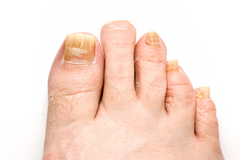 Fungal Laser Nail Treatment in the Cook County, IL: Chicago (Cicero, Evanston, Skokie, Berwyn, Oak Park, Park Ridge, Niles, Morton Grove, Elmwood Park, Melrose Park, Maywood, Norridge, Forest Park) areas