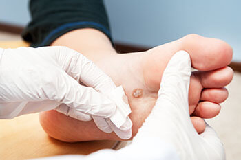 Plantar warts treatment in the Cook County, IL: Chicago (Cicero, Evanston, Skokie, Berwyn, Oak Park, Park Ridge, Niles, Morton Grove, Elmwood Park, Melrose Park, Maywood, Norridge, Forest Park) areas